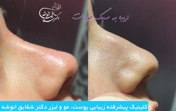 عکس قبل بعد فیلر بینی