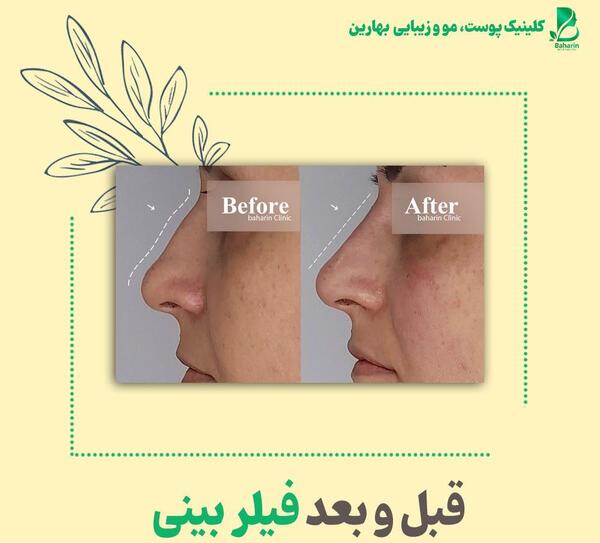 عکس قبل بعد فیلر بینی