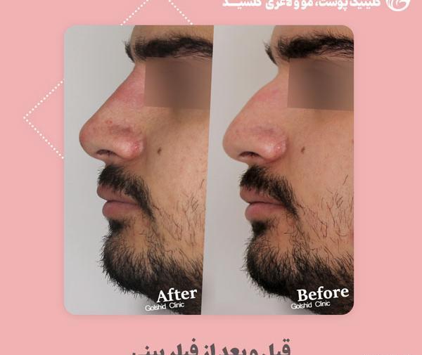 عکس قبل بعد فیلر بینی