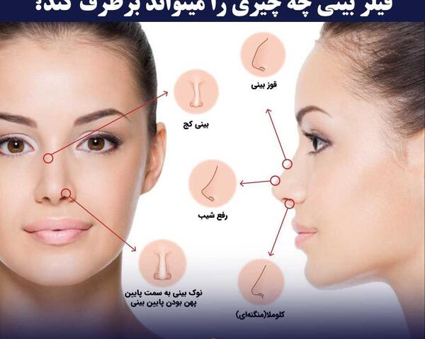 عکس قبل بعد فیلر بینی