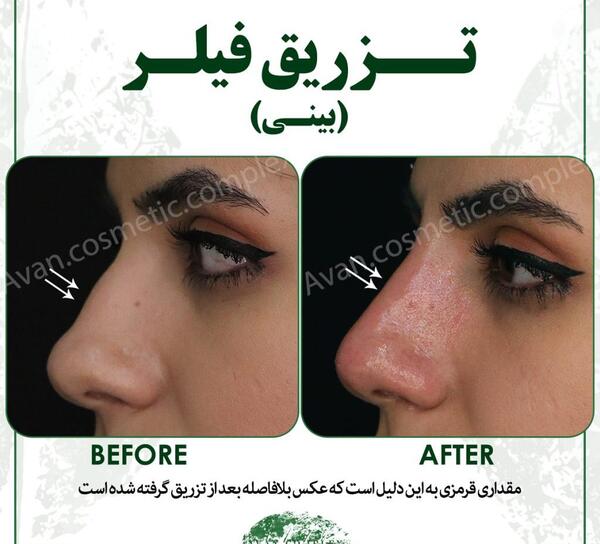 عکس قبل بعد فیلر بینی