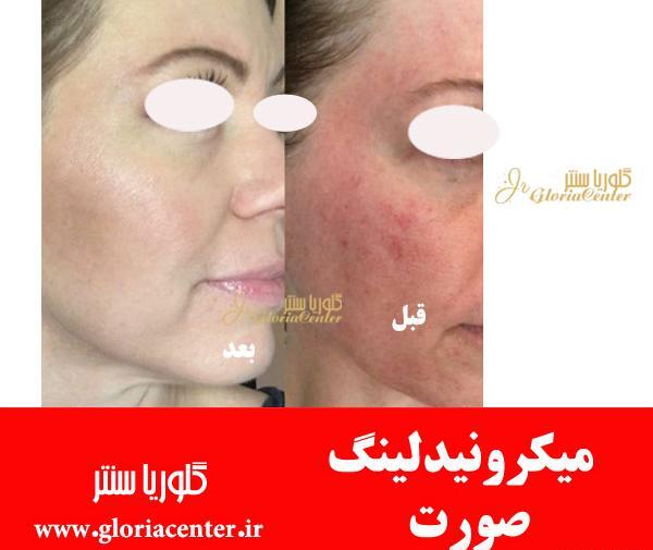 عکس های قبل و بعد مزونیدلینگ