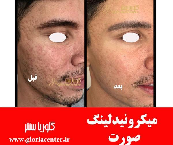 عکس های قبل و بعد مزونیدلینگ