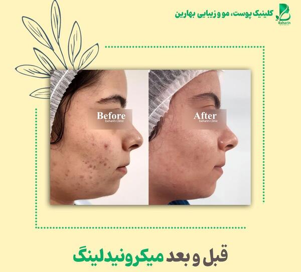 عکس های قبل و بعد مزونیدلینگ