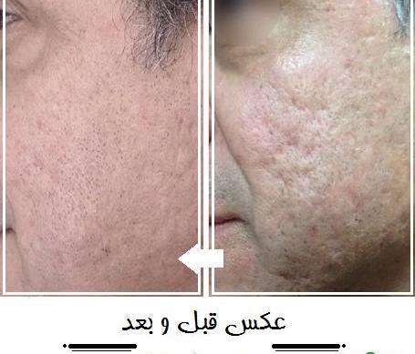 عکس های قبل و بعد مزونیدلینگ