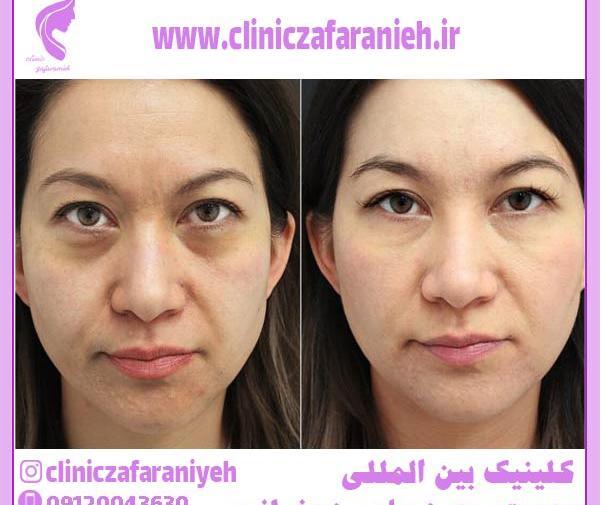 عکس های قبل و بعد مزونیدلینگ