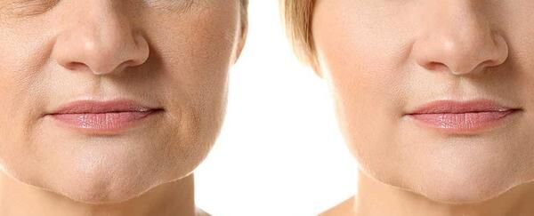 عکس های قبل و بعد مزونیدلینگ