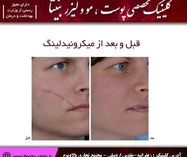 عکس های قبل و بعد مزونیدلینگ