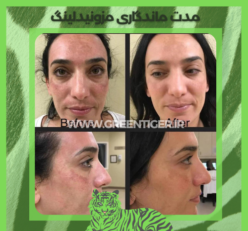 عکس های قبل و بعد مزونیدلینگ