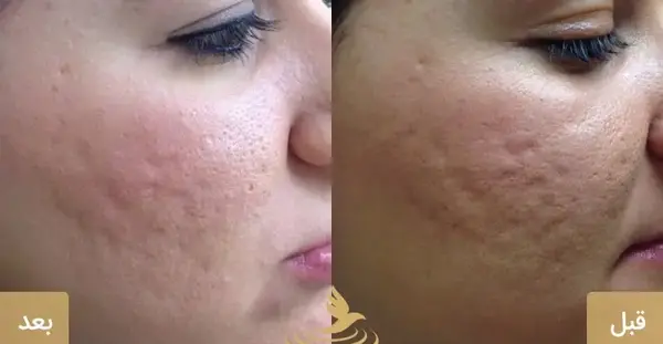 عکس های قبل و بعد مزونیدلینگ