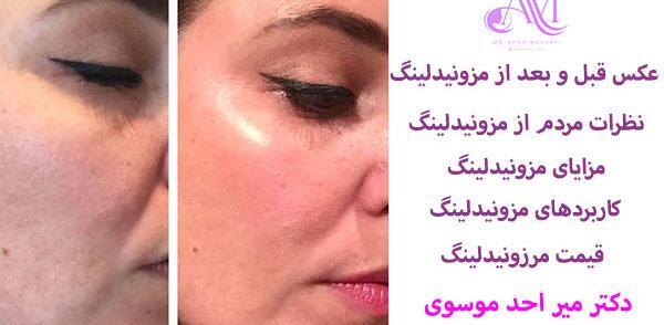 عکس های قبل و بعد مزونیدلینگ