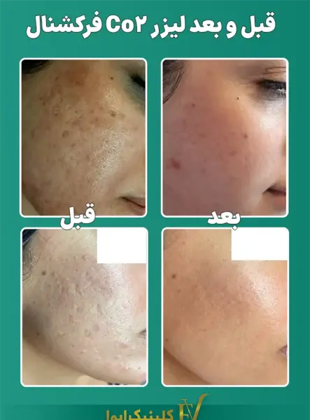 ليزر فركشنال عکس قبل و بعد از لیزر جای جوش