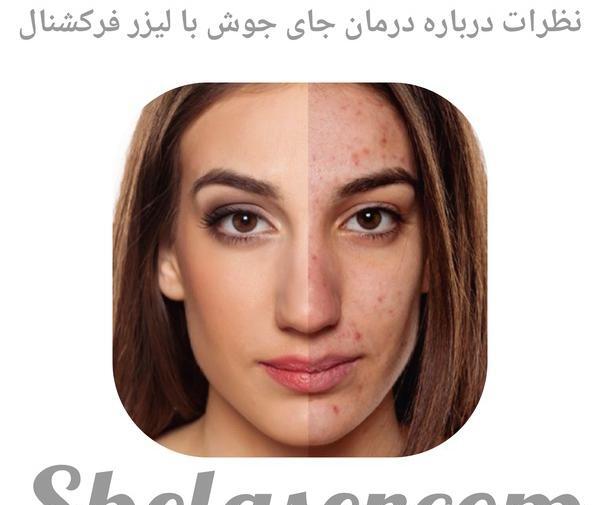 ليزر فركشنال عکس قبل و بعد از لیزر جای جوش