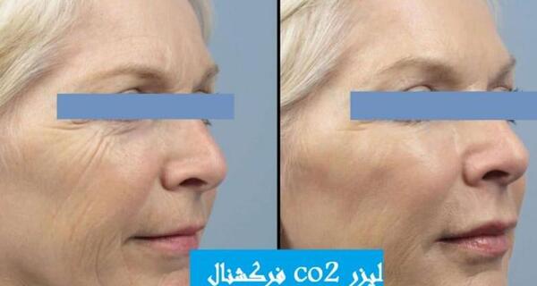 ليزر فركشنال عکس قبل و بعد از لیزر جای جوش