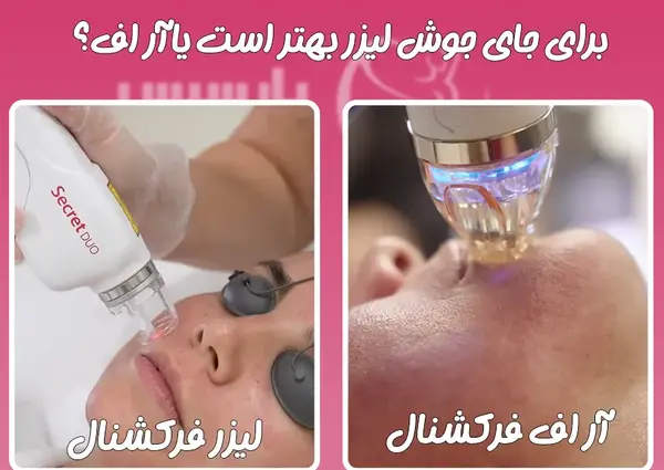ليزر فركشنال عکس قبل و بعد از لیزر جای جوش