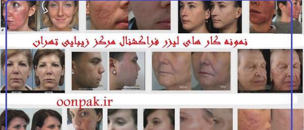 ليزر فركشنال عکس قبل و بعد از لیزر جای جوش