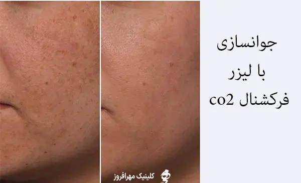 ليزر فركشنال عکس قبل و بعد از لیزر جای جوش