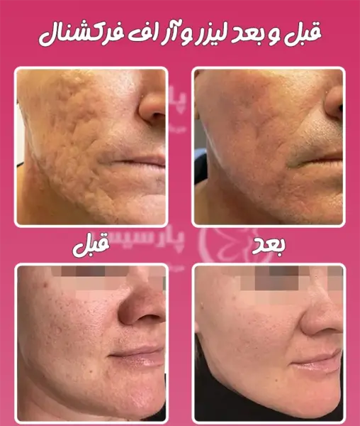 ليزر فركشنال عکس قبل و بعد از لیزر جای جوش