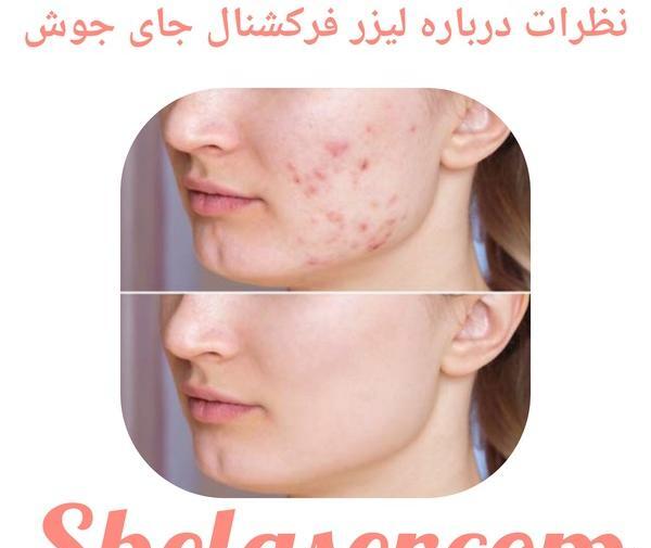 ليزر فركشنال عکس قبل و بعد از لیزر جای جوش