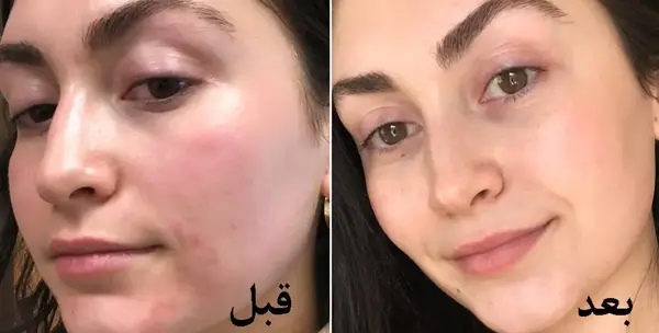 ليزر فركشنال عکس قبل و بعد از لیزر جای جوش