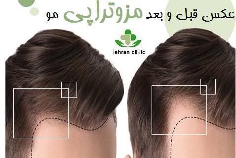 عکس های قبل و بعد مزوتراپی صورت