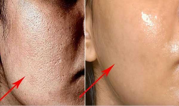 عکس های قبل و بعد مزوتراپی صورت