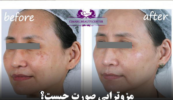 عکس های قبل و بعد مزوتراپی صورت