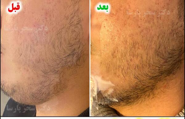 عکس های قبل و بعد مزوتراپی صورت