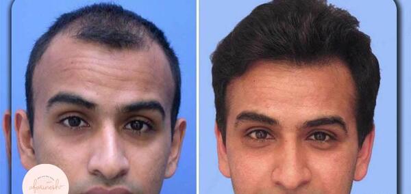 عکس های قبل و بعد مزوتراپی صورت
