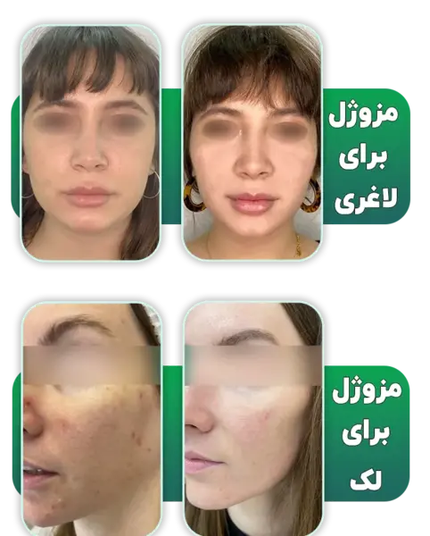 عکس های قبل و بعد مزوتراپی صورت