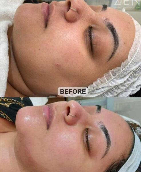 عکس های قبل و بعد مزوتراپی صورت
