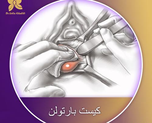 غده عکس واقعی کیست بارتولن