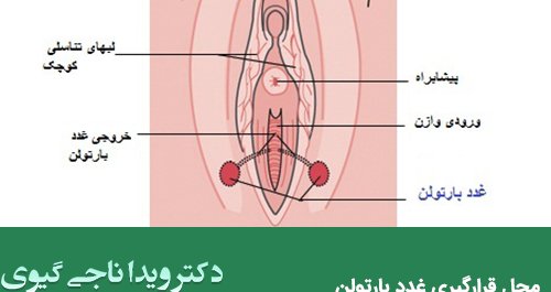 غده عکس واقعی کیست بارتولن
