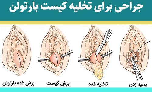 غده عکس واقعی کیست بارتولن