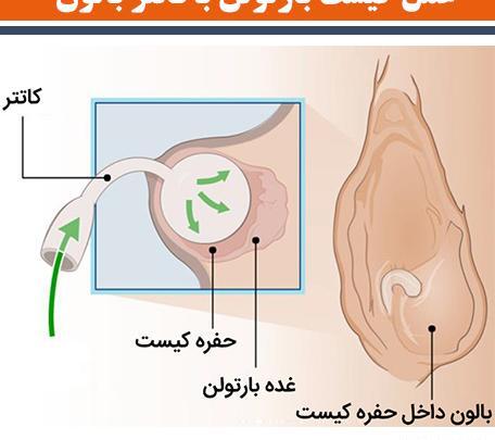غده عکس واقعی کیست بارتولن