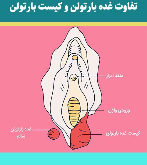غده عکس واقعی کیست بارتولن
