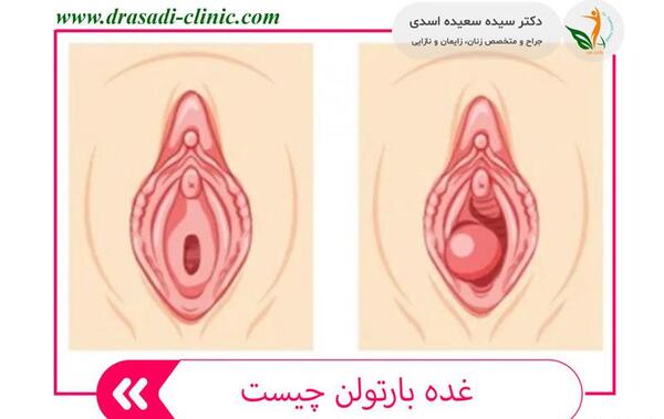 تخليه كيست عکس واقعی کیست بارتولن