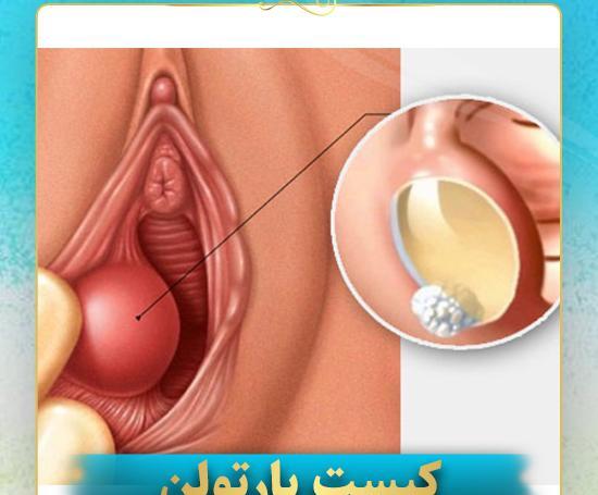 تخليه كيست عکس واقعی کیست بارتولن
