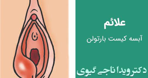 تخليه كيست عکس واقعی کیست بارتولن