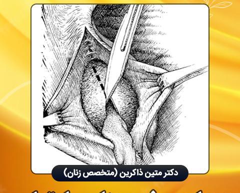 تخليه كيست عکس واقعی کیست بارتولن