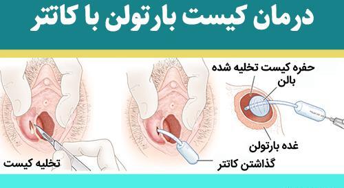 تخليه كيست عکس واقعی کیست بارتولن