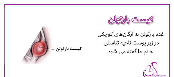 تخليه كيست عکس واقعی کیست بارتولن