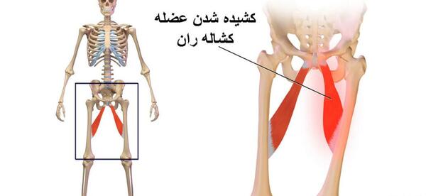 عکس واقعی غدد لنفاوی کشاله ران در مردان