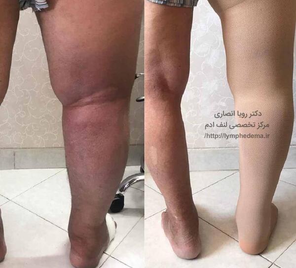 عکس واقعی غدد لنفاوی کشاله ران در مردان