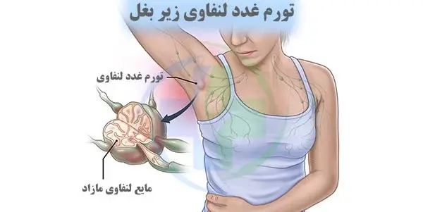 سرطآن لنفوم عکس واقعی غدد لنفاوی کشاله ران