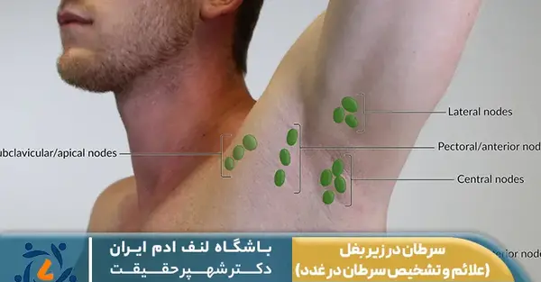 سرطآن لنفوم عکس واقعی غدد لنفاوی کشاله ران