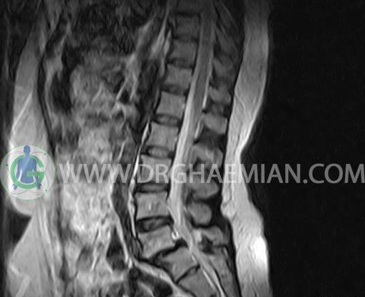 عکس واقعی ستون فقرات انسان