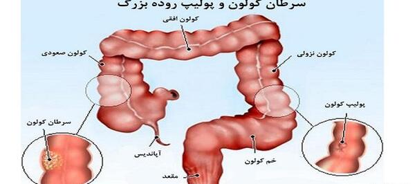 عکس واقعی روده بزرگ انسان