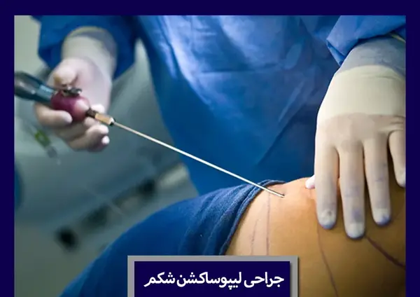جراحی عکس واقعی چربی شکم