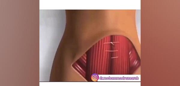 جراحی عکس واقعی چربی شکم